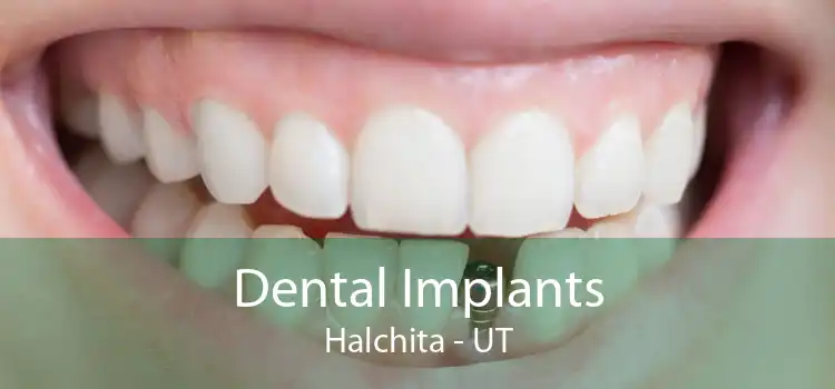Dental Implants Halchita - UT