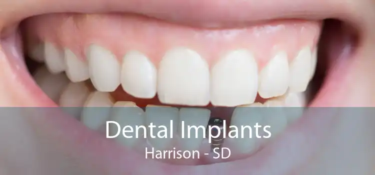 Dental Implants Harrison - SD