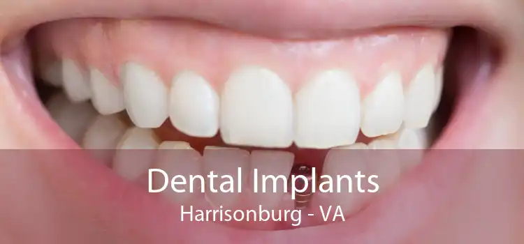 Dental Implants Harrisonburg - VA