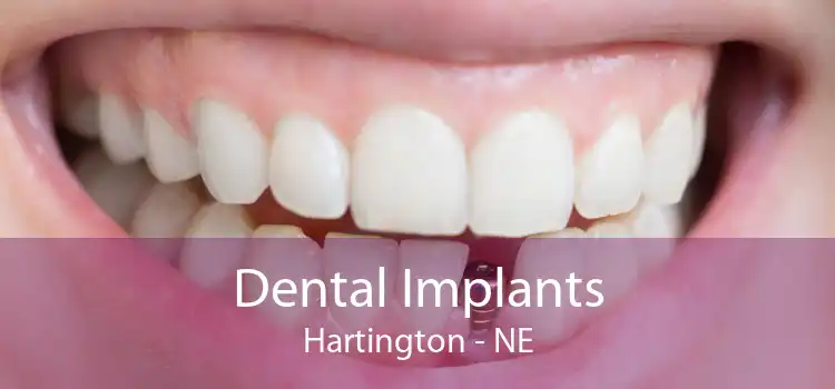 Dental Implants Hartington - NE