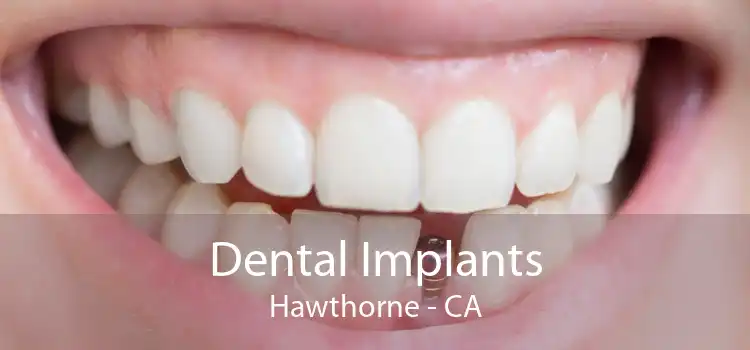 Dental Implants Hawthorne - CA