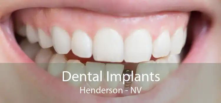 Dental Implants Henderson - NV