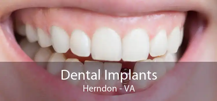 Dental Implants Herndon - VA