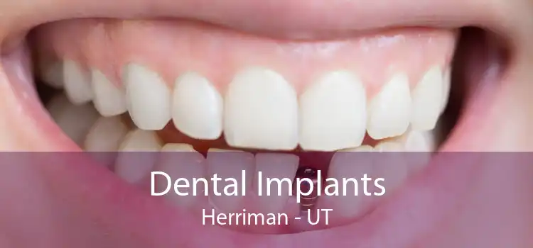 Dental Implants Herriman - UT