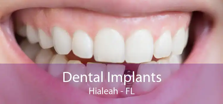 Dental Implants Hialeah - FL
