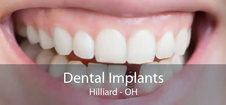 Dental Implants Hilliard - OH
