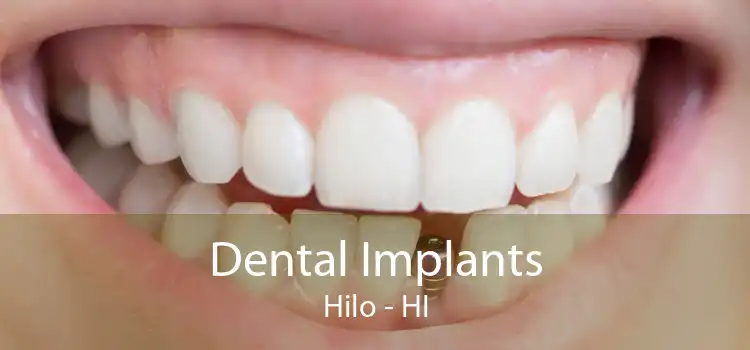 Dental Implants Hilo - HI