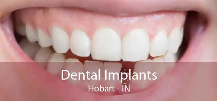 Dental Implants Hobart - IN