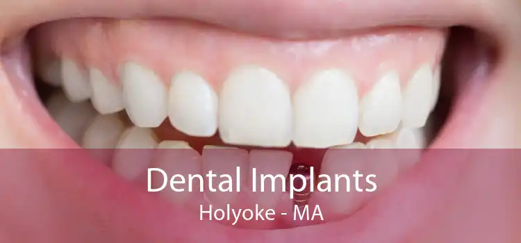 Dental Implants Holyoke - MA