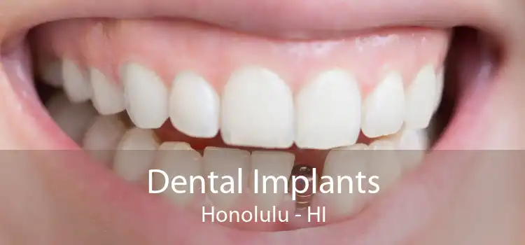 Dental Implants Honolulu - HI