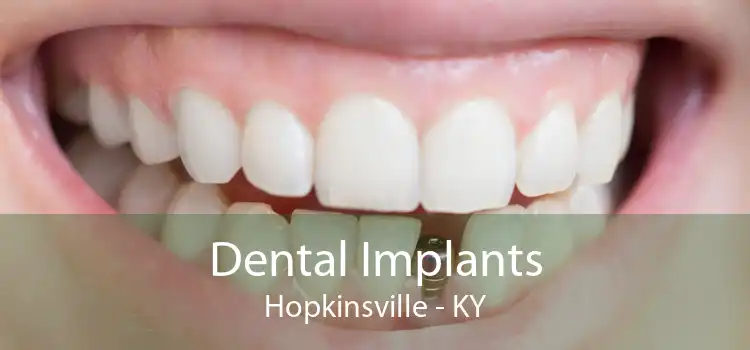 Dental Implants Hopkinsville - KY