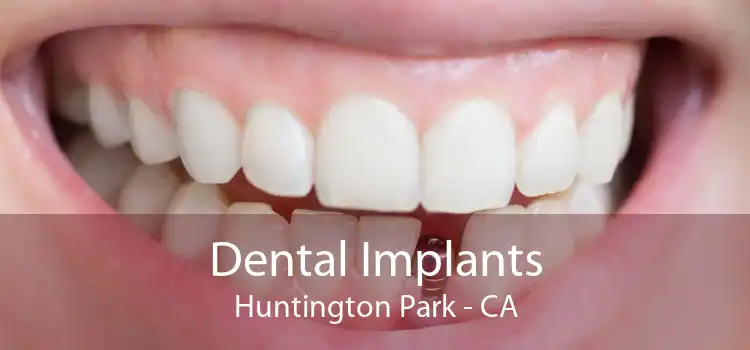 Dental Implants Huntington Park - CA