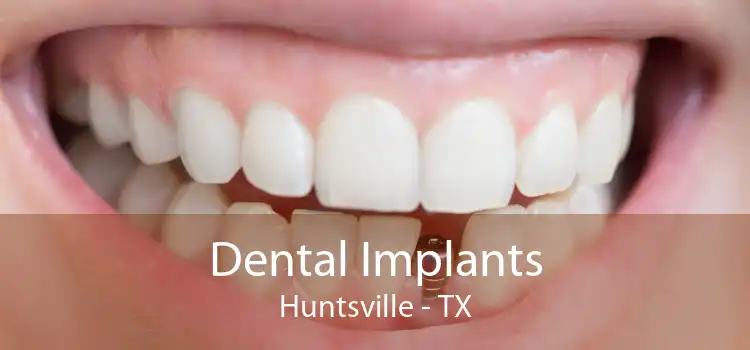 Dental Implants Huntsville - TX