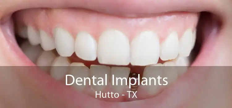 Dental Implants Hutto - TX