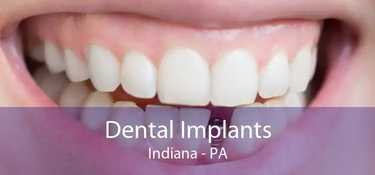 Dental Implants Indiana - PA