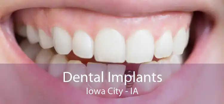 Dental Implants Iowa City - IA