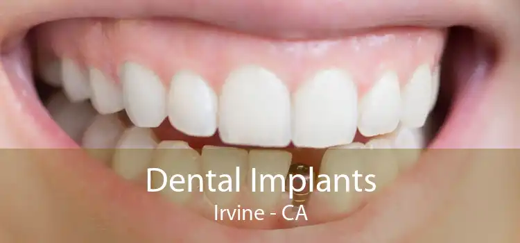 Dental Implants Irvine - CA