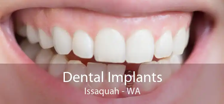 Dental Implants Issaquah - WA