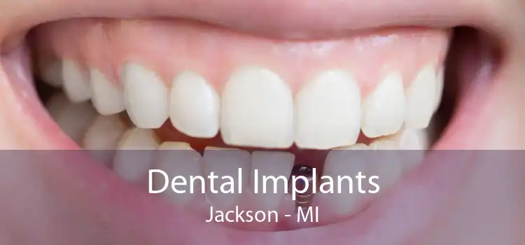 Dental Implants Jackson - MI
