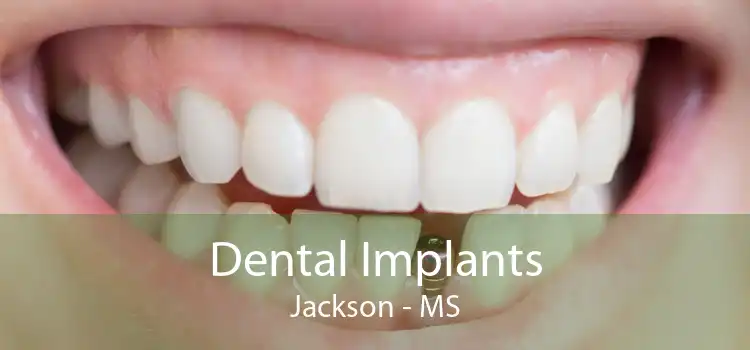 Dental Implants Jackson - MS
