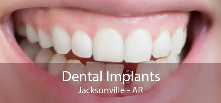 Dental Implants Jacksonville - AR