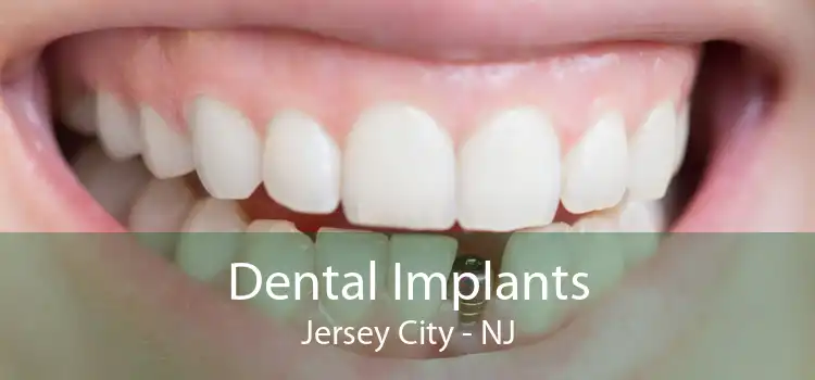 Dental Implants Jersey City - NJ