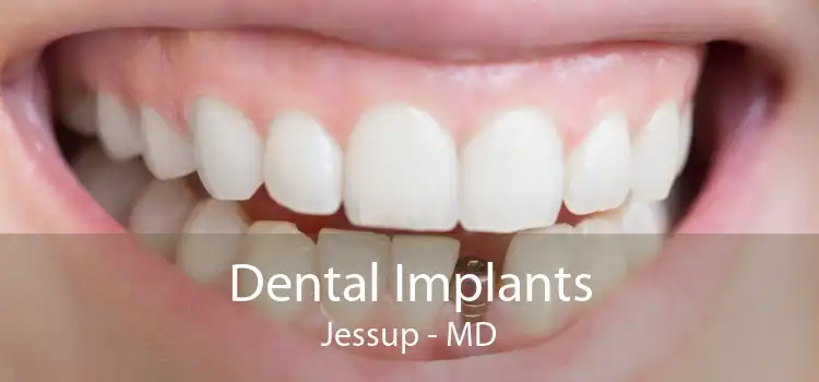 Dental Implants Jessup - MD
