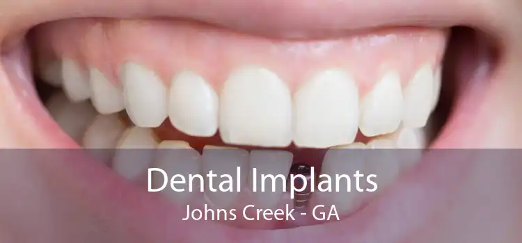 Dental Implants Johns Creek - GA