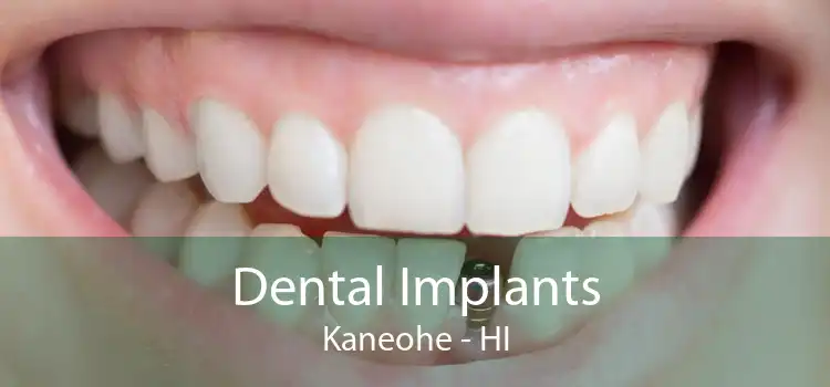 Dental Implants Kaneohe - HI