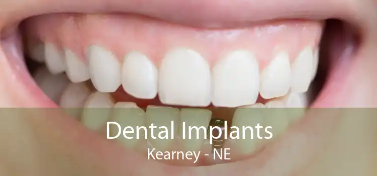 Dental Implants Kearney - NE