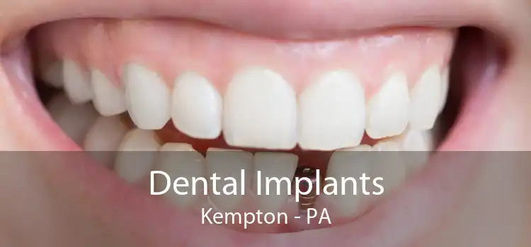 Dental Implants Kempton - PA