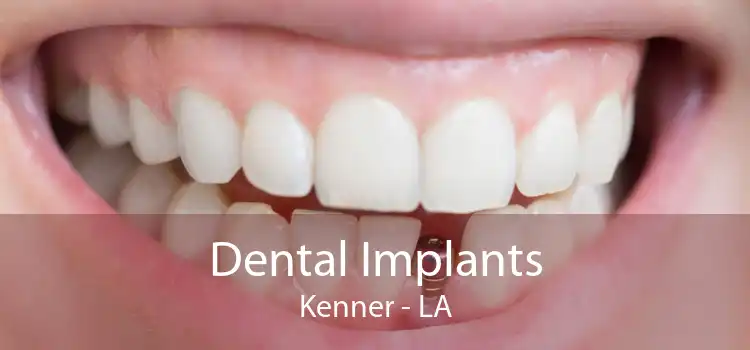 Dental Implants Kenner - LA