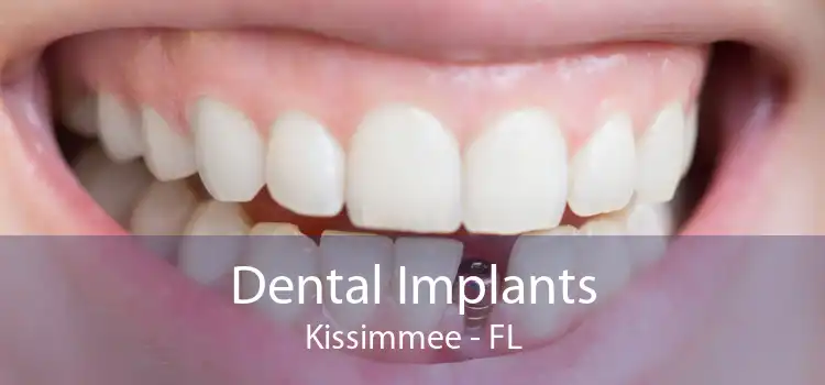 Dental Implants Kissimmee - FL