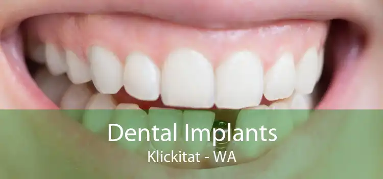 Dental Implants Klickitat - WA