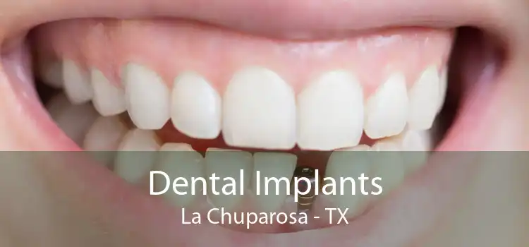 Dental Implants La Chuparosa - TX