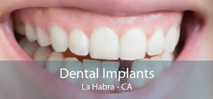 Dental Implants La Habra - CA