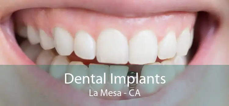 Dental Implants La Mesa - CA