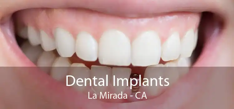 Dental Implants La Mirada - CA