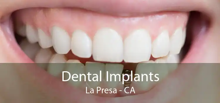 Dental Implants La Presa - CA