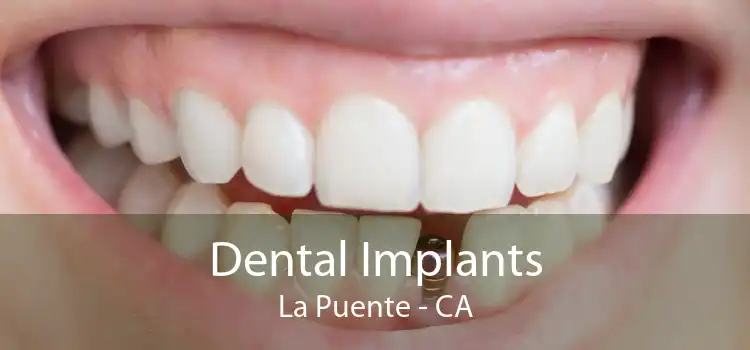Dental Implants La Puente - CA