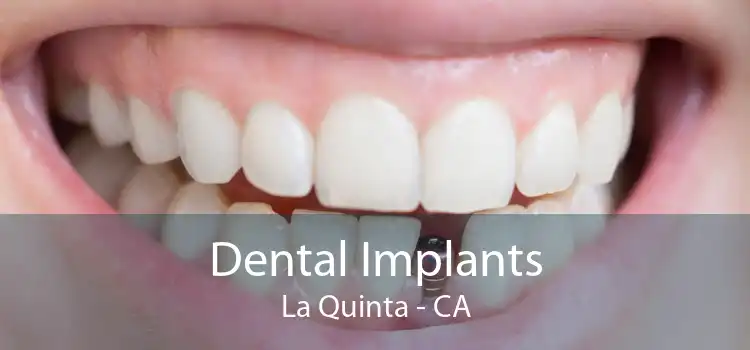 Dental Implants La Quinta - CA
