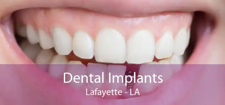 Dental Implants Lafayette - LA