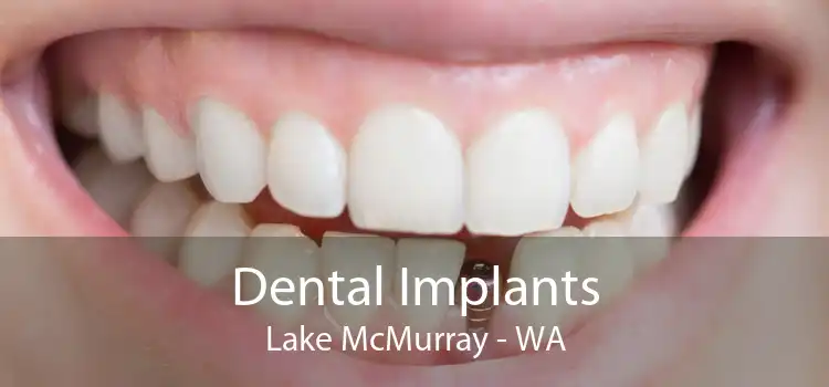 Dental Implants Lake McMurray - WA