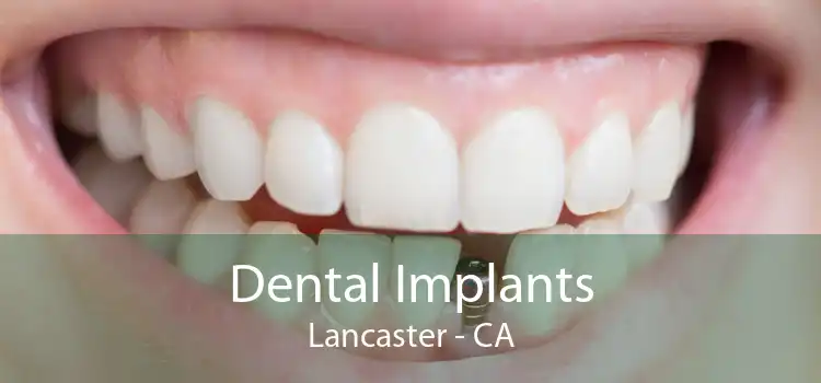 Dental Implants Lancaster - CA