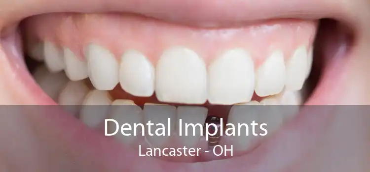 Dental Implants Lancaster - OH