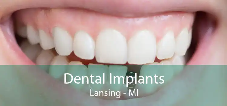Dental Implants Lansing - MI