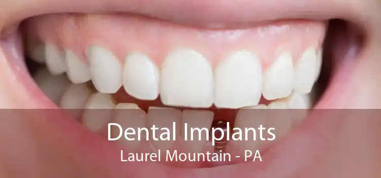 Dental Implants Laurel Mountain - PA