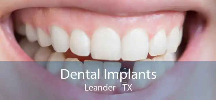 Dental Implants Leander - TX