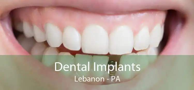 Dental Implants Lebanon - PA