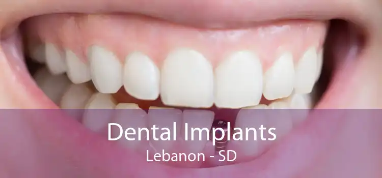 Dental Implants Lebanon - SD